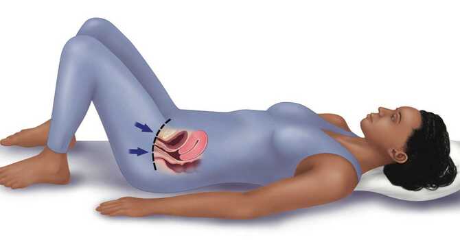 Urinary Incontinence  image